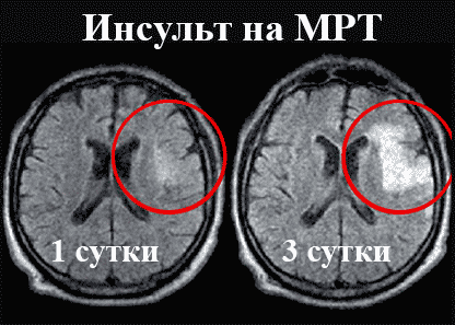 Первые признаки инсульта на МРТ