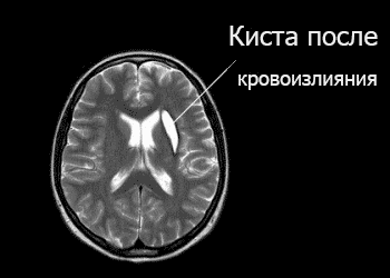 Киста головного мозга на МРТ